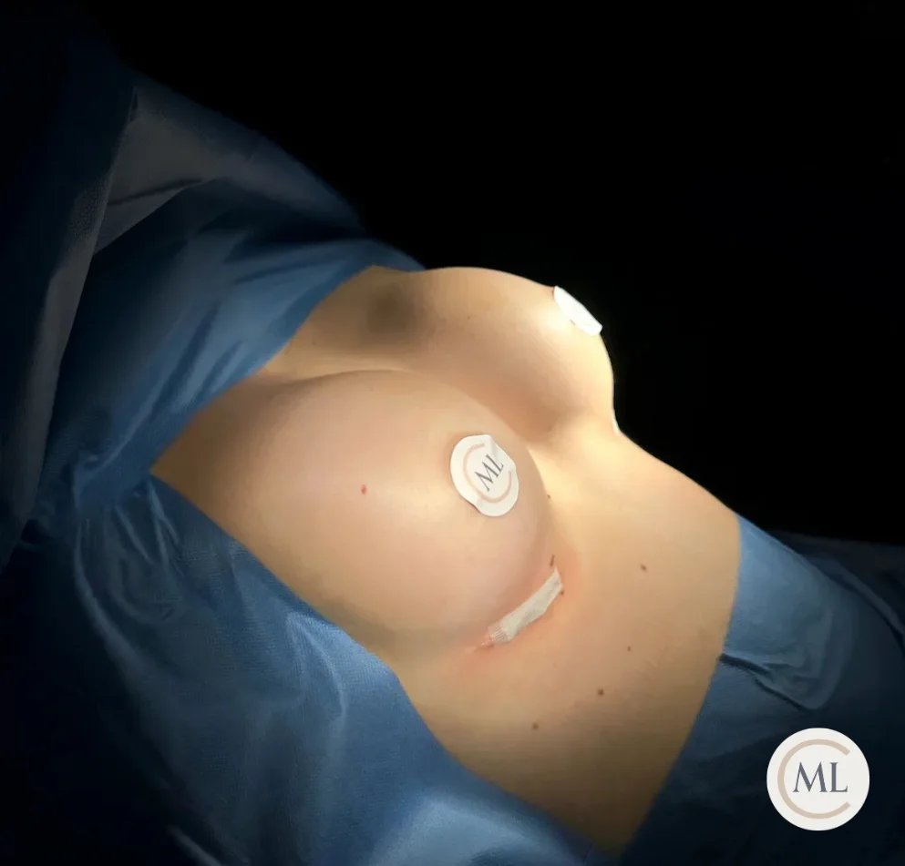 aumento de pecho en madrid realizado por Cirugia Plástica de Millán Longo y Asociados tras intervención