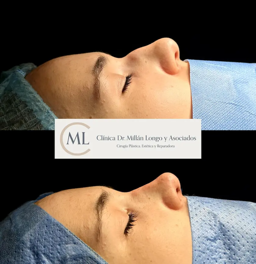 despues de rinoplastia tras intervencion