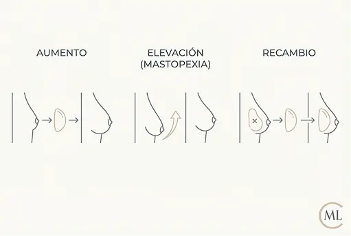 diferencia grafica aumento pecho elevacion y recambio cirugia mamaria aumento millan longo