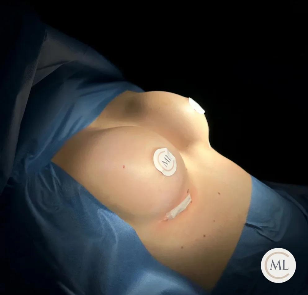 aumento de pecho madrid - cirugia plastica madrid - Clinica Dr. Millan Longo y Asociados