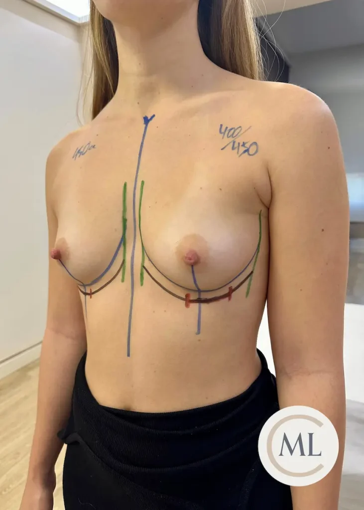 aumento de pecho madrid paciente cirugia mamaria mamoplastia aumento - cirugia plastica madrid