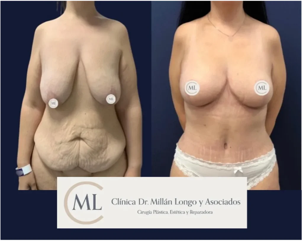 mommy makeover - caso 1 - imagen 1