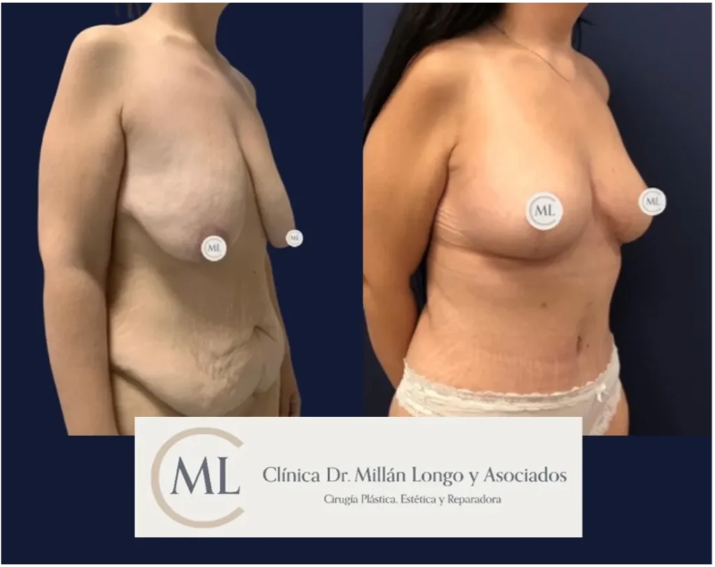 mommy makeover - caso 1 - imagen 2