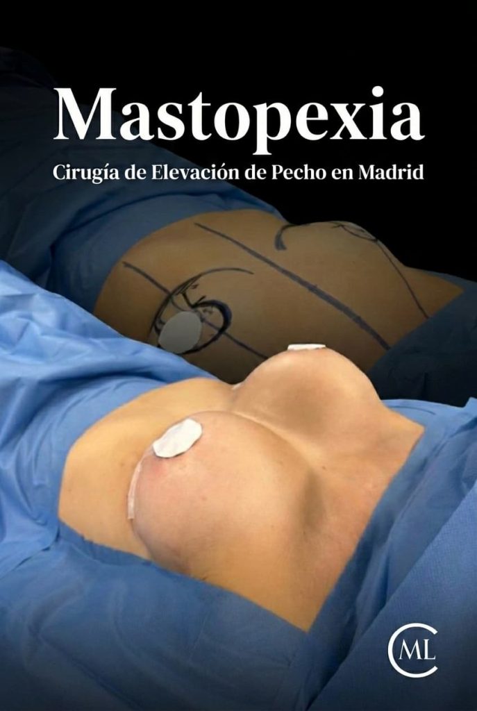 mastopexia madrid - elevacion de pecho cirugia plastica madrid Clínica Dr. Millán Longo y Asociados (1)