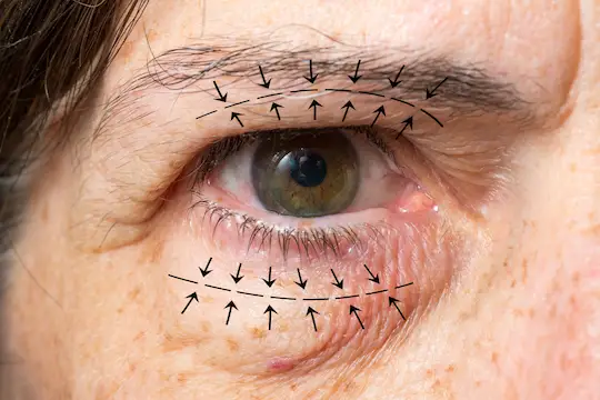 blefaroplastia completa madrid en la clinica de cirugia plastia millan longo y asociados