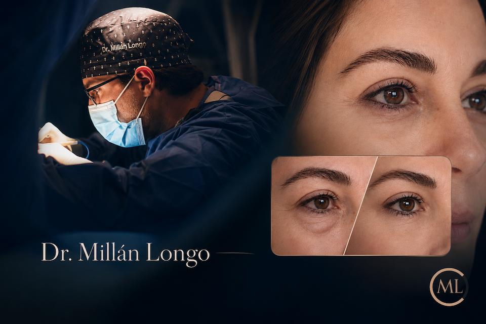 blefaroplastia en madrid con el dr. millan longo - cirugia plastica en madrid