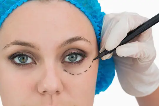 blefaroplastia inferior en madrid en clinica cirugia Millan Longo
