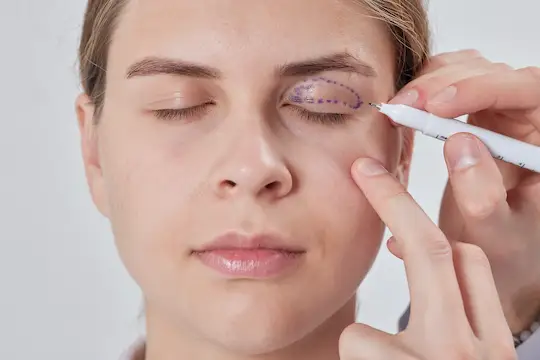 blefaroplastia superior en madrid - millan longo