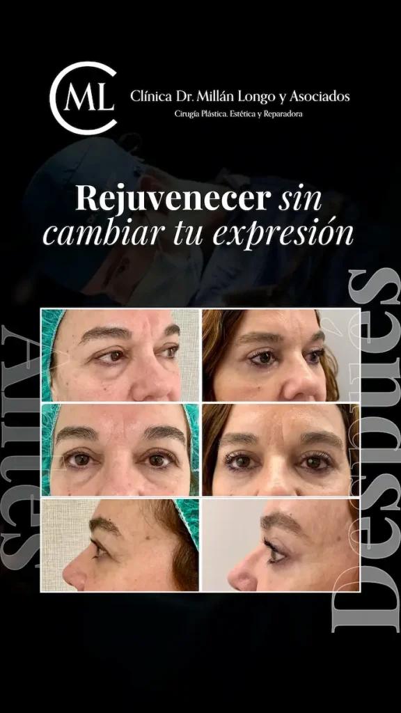 pacientes millan longo blefaroplastia en madrid