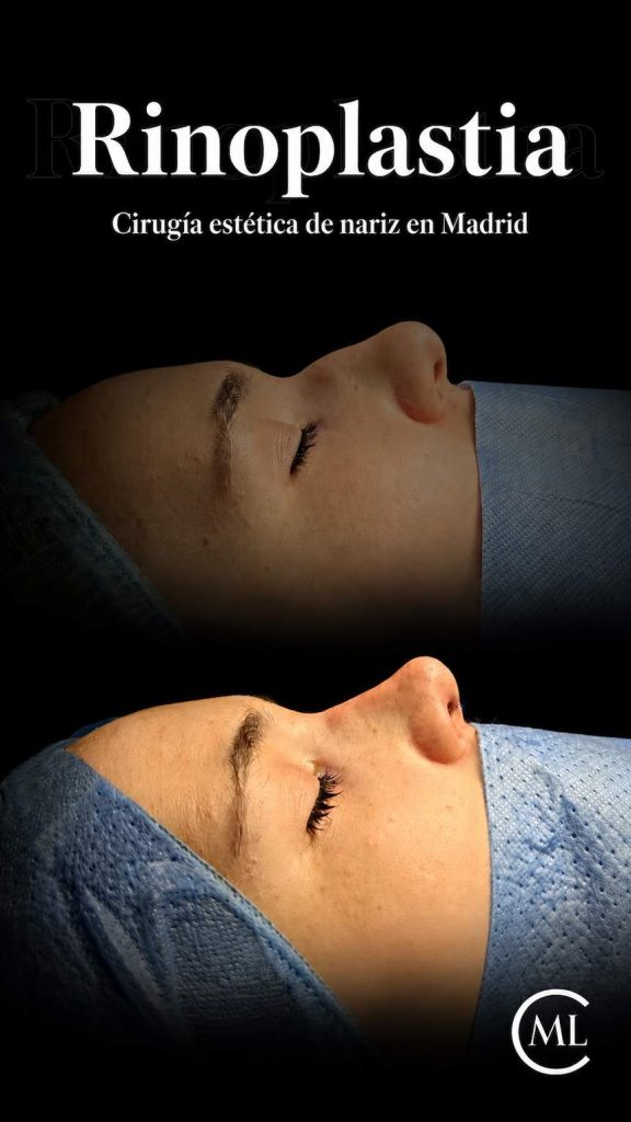 rinoplastia Madrid con cirujano plastico Alberto Millán Longo