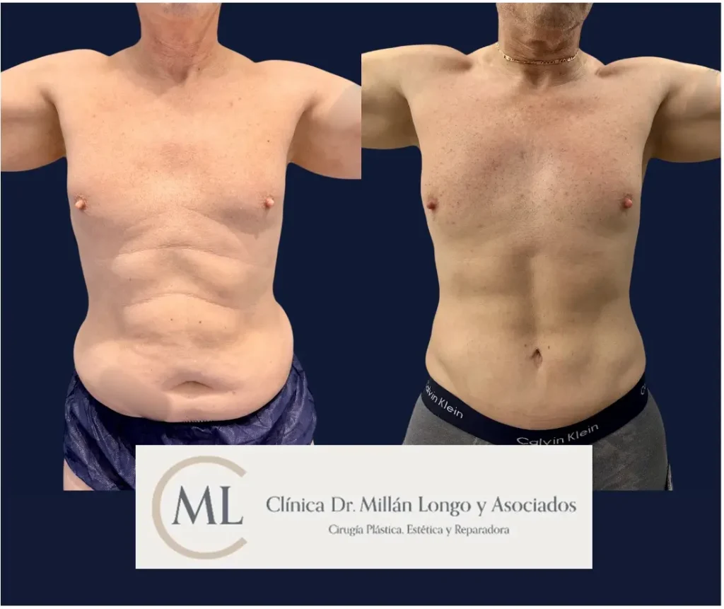 abdominoplastia en madrid en hombre - caso 2 imagen 01 - clinica millan longo y asociados