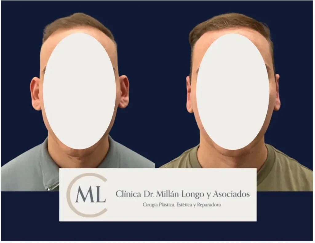 antes despues otoplastia caso 1 - clinica millan longo - imagen 1