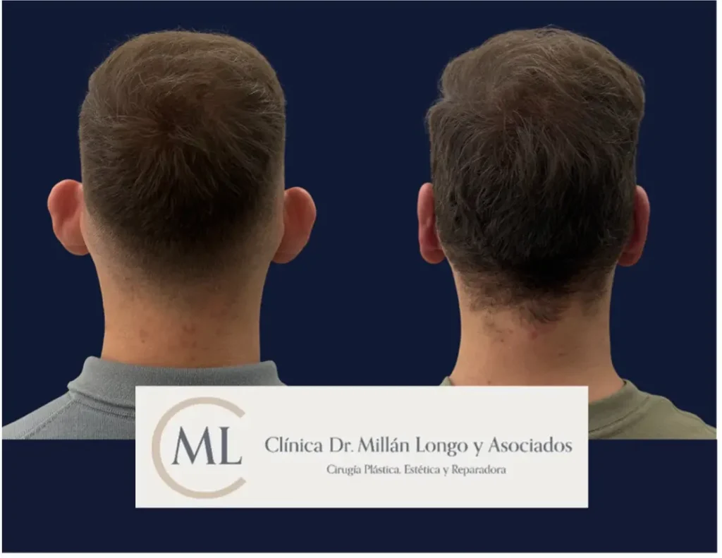 antes despues otoplastia caso 1 - clinica millan longo - imagen 2