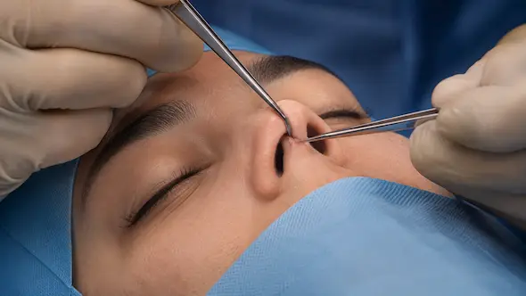 rinoplastia abierta en madrid - tecnica de rinoplastia realizada en Clinica Millan Longo y Asociados