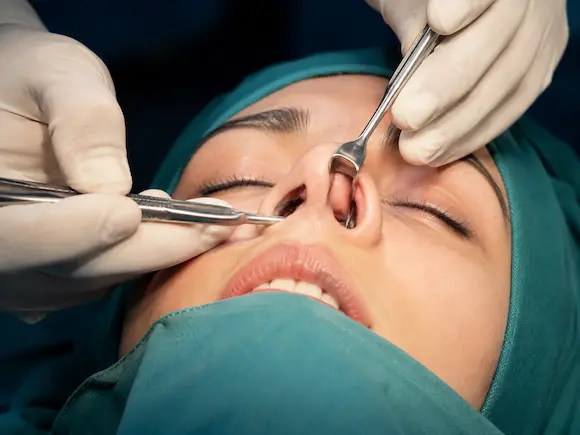 rinoplastia cerrada en madrid con el cirujano plastico alberto millan longo