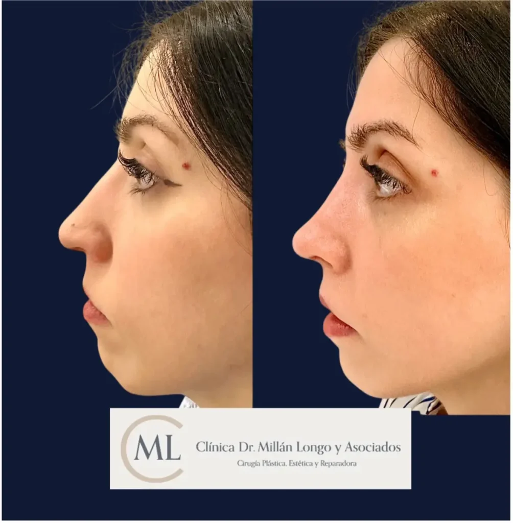 rinoplastia en madrid caso 2 - clinica millan longo - imagen 2