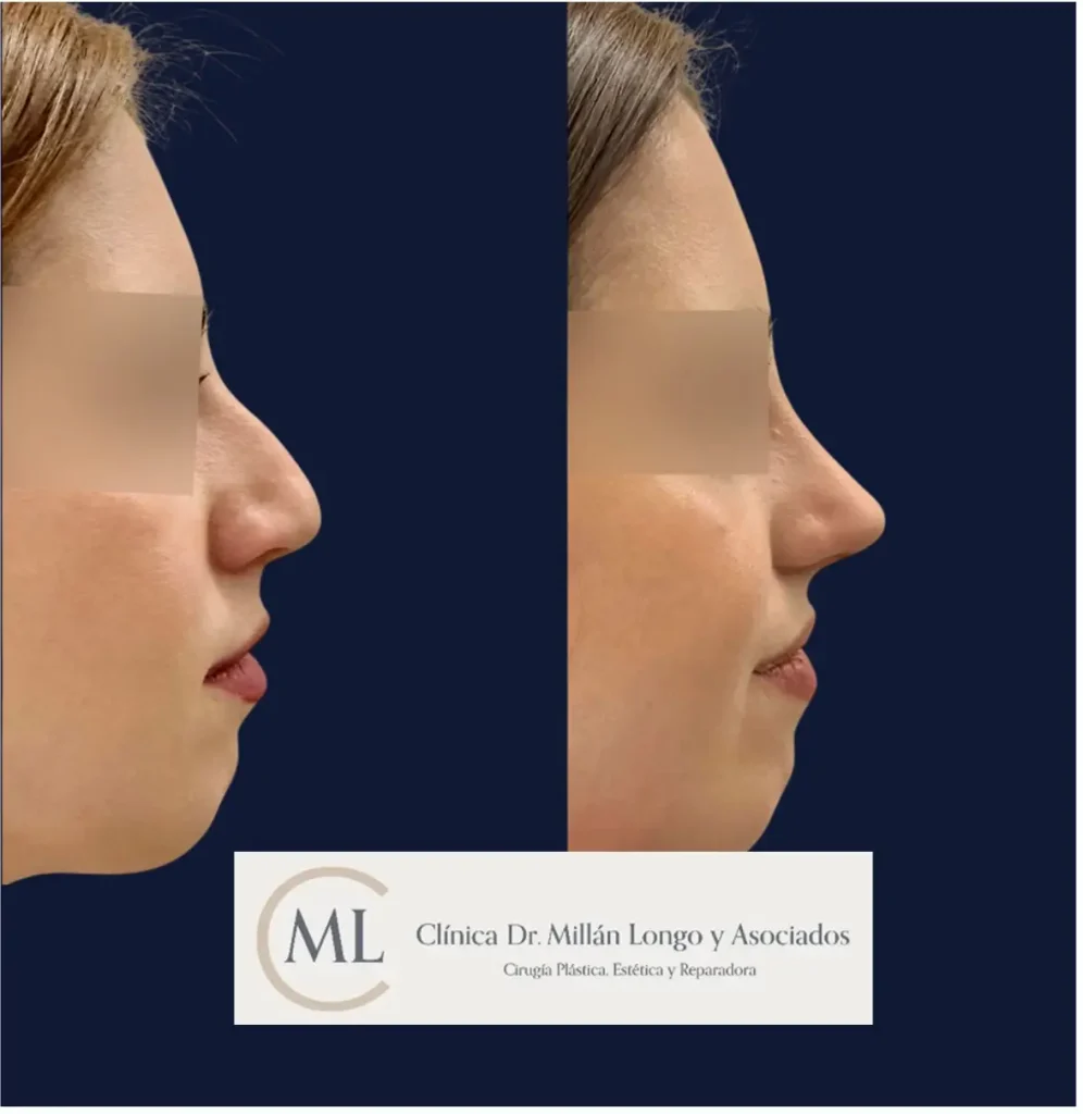 antes y despues rinoplastia en madrid caso 3 - clinica millan longo - imagen 1