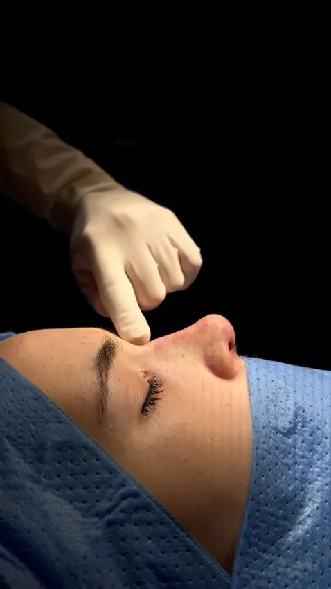 rinoplastia millan longo - img intervencion rinoplastia en madrid