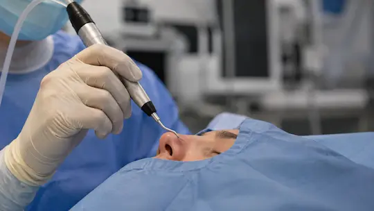 rinoplastia ultrasonica tecnica empleada por cirugia plastica millan longo en madrid