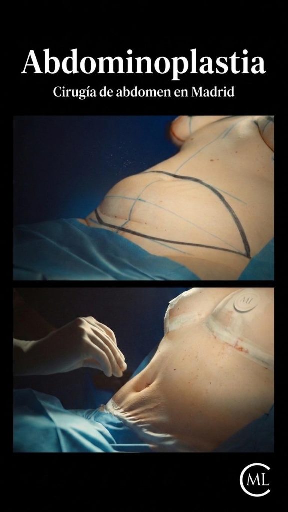 abdominoplastia madrid - clinica millan longo cirugia plastica madrid