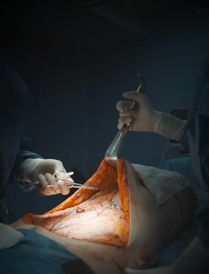 abdominoplastia realizada en madrid por millan longo cirugia plastica