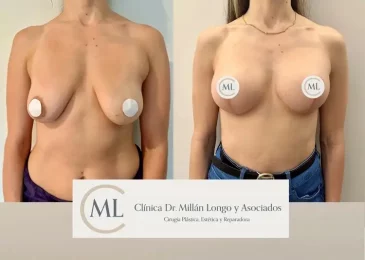 mastopexia con protesis